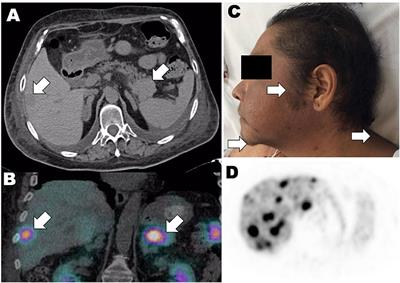 Frontiers | High Molecular Weight ACTH-Precursor Presence In A ...